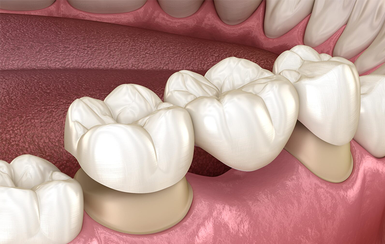 Dental Bridges