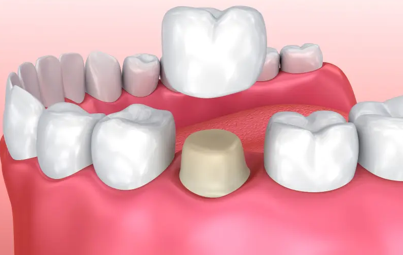 Dental Crowns