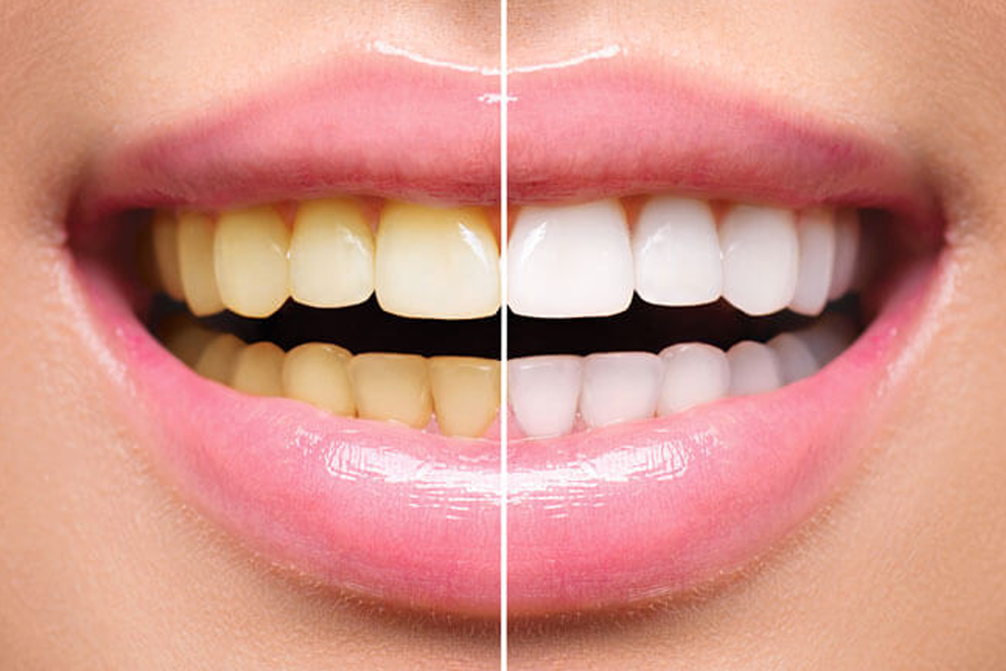 Whitening